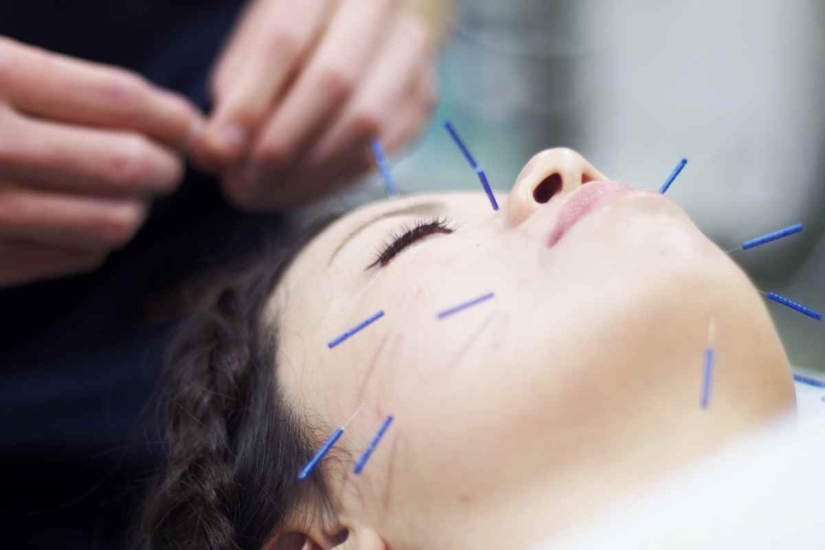 Acupuncture For Balanced Wellness
