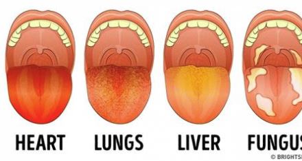 13 Things Your Tongue Is Trying to Tell You About Your Health - Easy ...