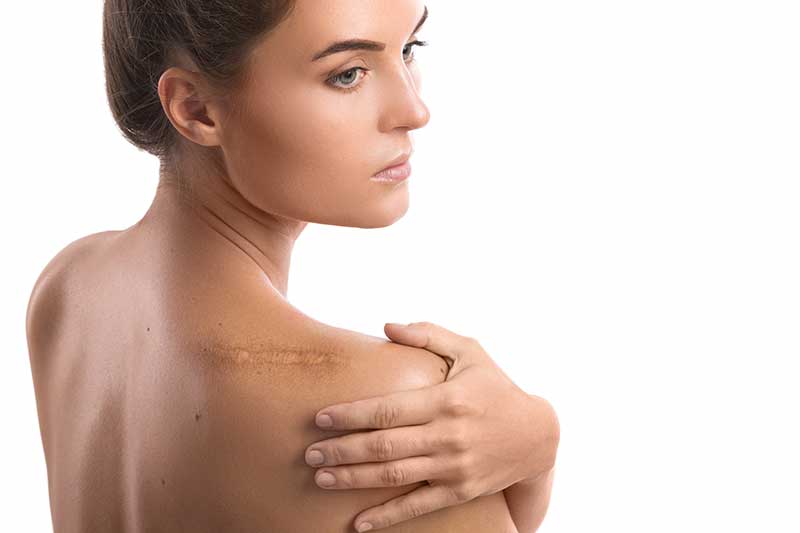 Cupping for Scar Tissue: How To Get Rid Of Scars Naturally