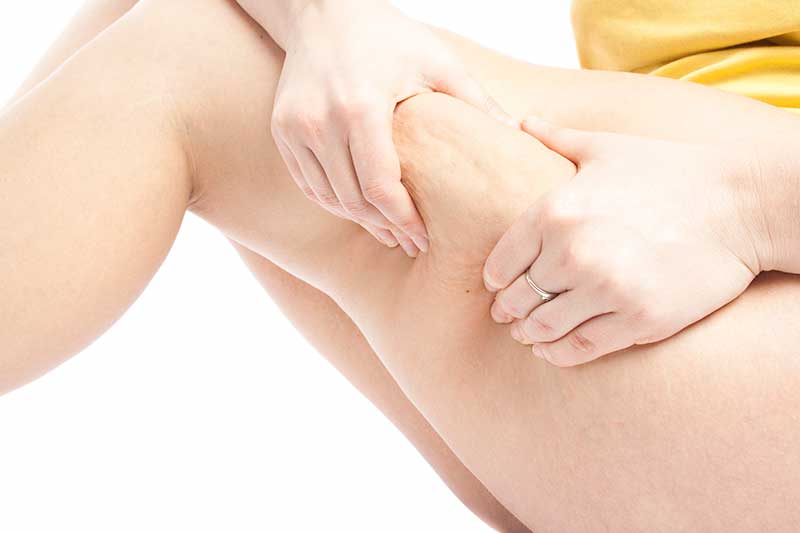 Does Cupping Work For Cellulite? Can I Do It At Home Safely?