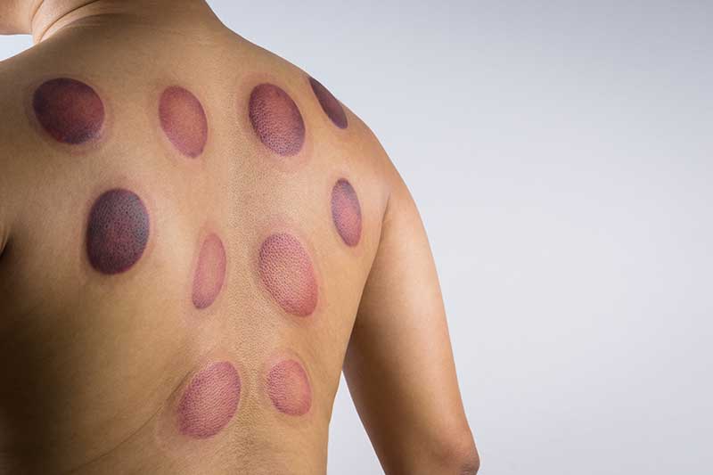 How To Get Rid Of Cupping Marks Faster