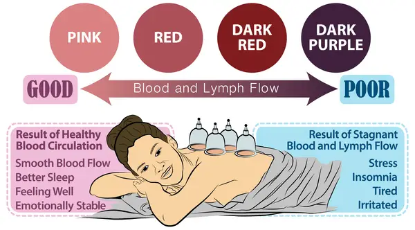 cupping-color-chart-why-does-cupping-leave-marks-and-what-are-their-meanings-tcm-tips-2022