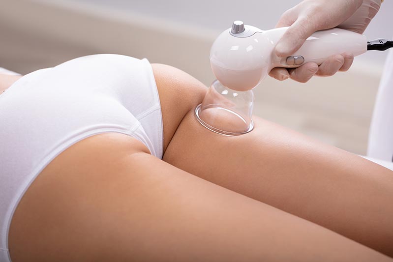 How Often Should You Do Cupping For Cellulite? And What Other Things You Need To Know.