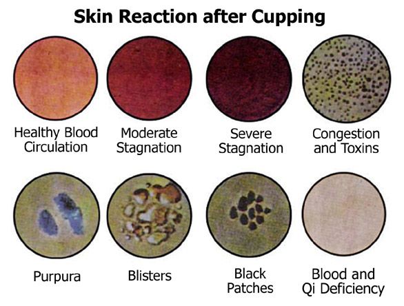 cupping-color-chart-why-does-cupping-leave-marks-and-what-are-their