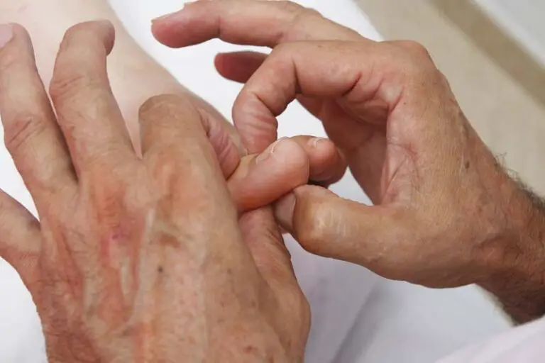 How to Massage A Bunion TCM Tips