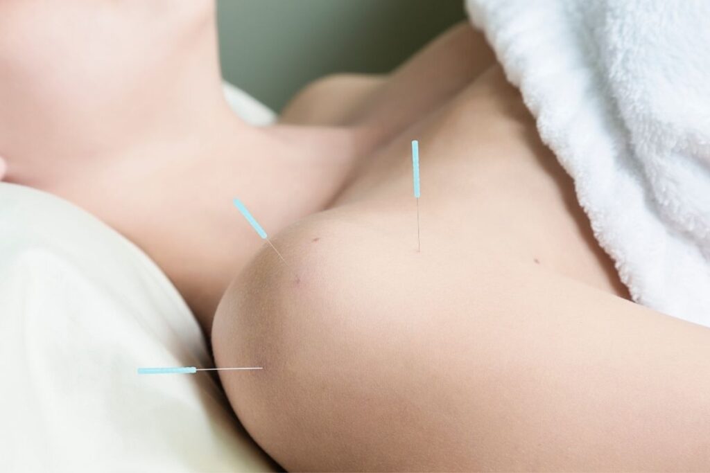 4 Best Acupuncture Clinics in San Francisco