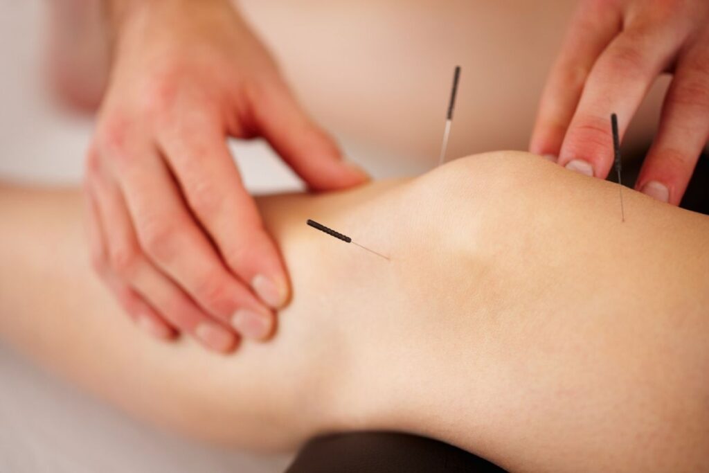 5-Best-Places-For-Acupuncture-In-Eugene