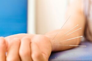 6 Best Acupuncture Clinics In Palm Springs