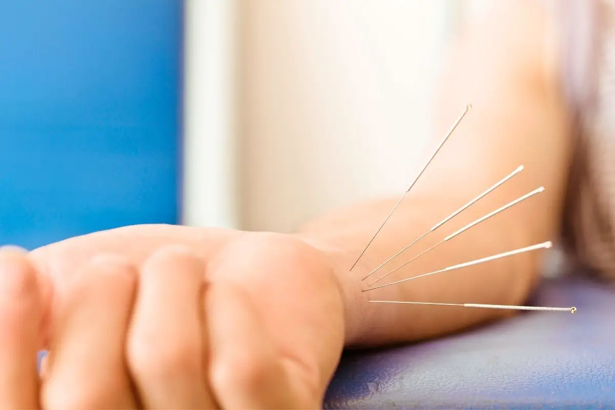 Acupuncture одежда. Акупунктура. Акупунктура коллагеновыми нитями. Иглорефлексотерапия для беременных.