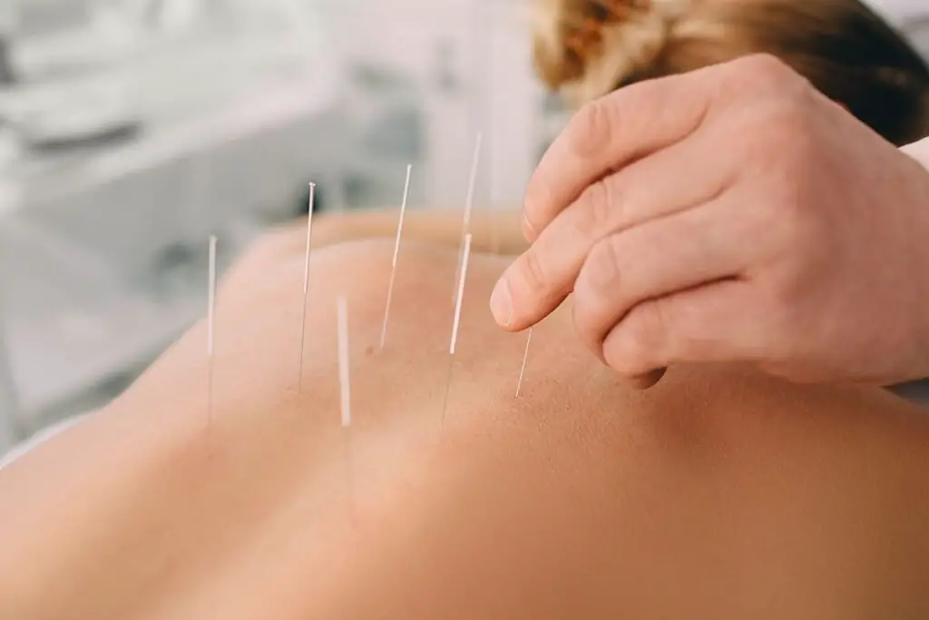 9 Best Acupuncture Clinics In Chicago