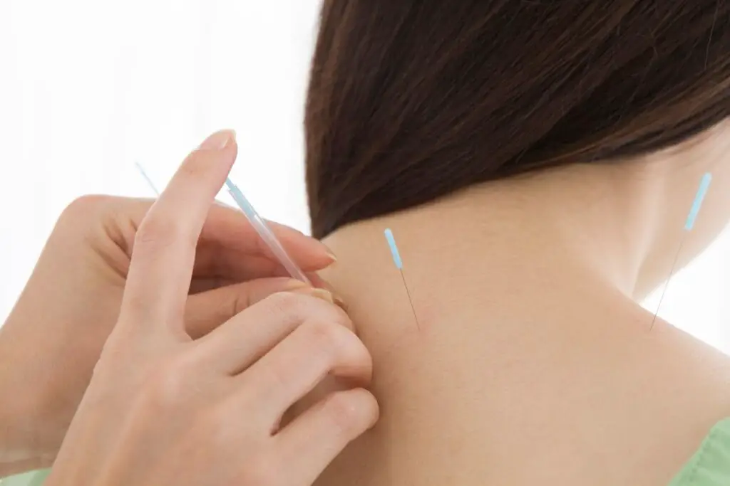 4 Best Acupuncture Clinics In San Francisco TCM Tips