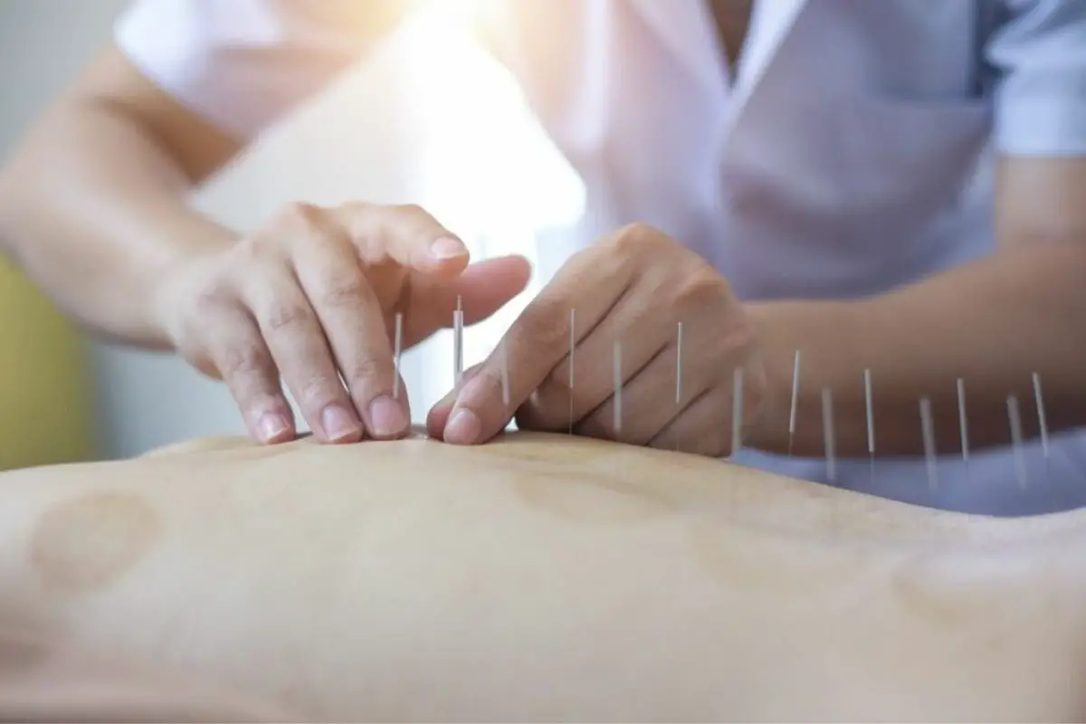 What Are The Benefits Of Acupuncture?