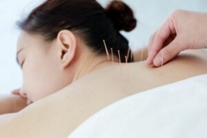 What Is Community Acupuncture?