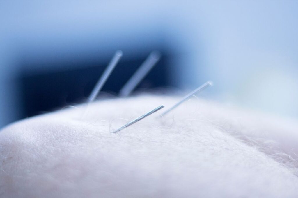 10 Best Acupuncture Clinics In Albany NY TCM Tips